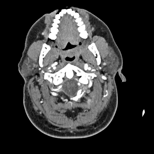 Cerebellar infarct due to vertebral artery dissection with posterior fossa decompression (Radiopaedia 82779-97029 C 58).png