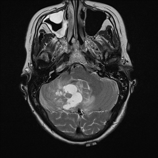 File:Cerebellar metastases (Radiopaedia 24038-24249 Axial T2 11).jpg