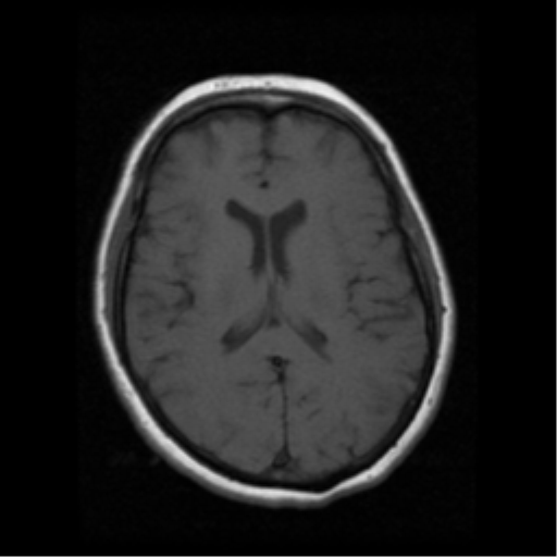 File:Cerebellar metastasis (cystic appearance) (Radiopaedia 41395-44262 Axial T1 13).png