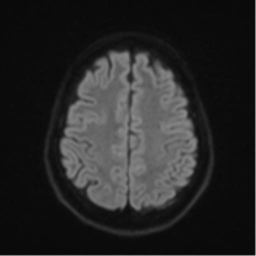 Cerebellar metastasis - adenocarcinoma lung (Radiopaedia 63184-71715 Axial DWI 51).png