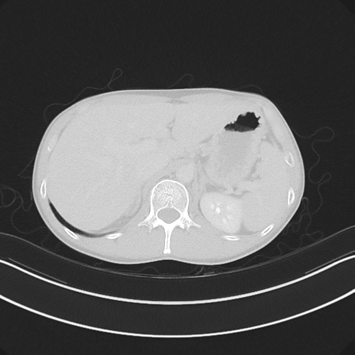 Cerebellar metastasis - adenocarcinoma lung (Radiopaedia 63184-71717 Axial lung window 68).png