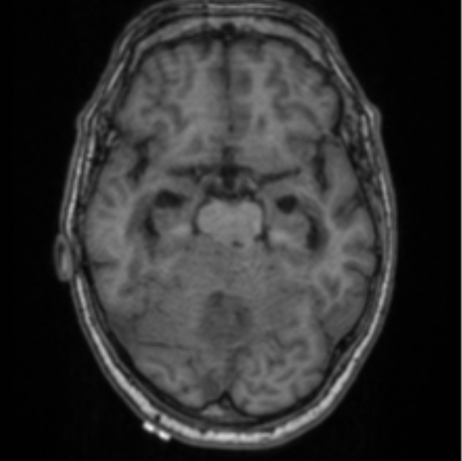 Cerebellar metastasis from lung adenocarcinoma (Radiopaedia 86690-102829 Axial T1 33).png
