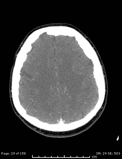File:Cerebellar strokes due to intracranial giant cell arteritis (Radiopaedia 68799-78510 CT angiogram 29).jpg