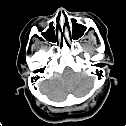 Cerebellopontine angle meningioma (Radiopaedia 35181-36714 A 41).jpg