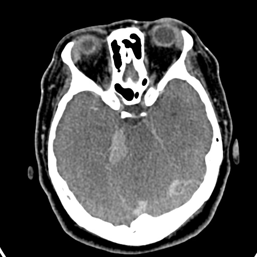 Cerebellopontine angle meningioma (Radiopaedia 35181-36714 A 9).jpg