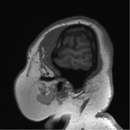 Cerebellopontine angle meningioma (Radiopaedia 48434-53348 Sagittal T1 13).png
