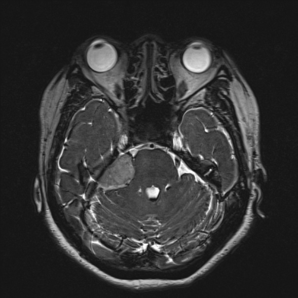 File:Cerebellopontine angle meningioma (Radiopaedia 53561-59591 Axial 3D volume T2 72).jpg