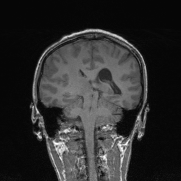 Cerebral abscess (Radiopaedia 24212-24478 Coronal T1 132).jpg