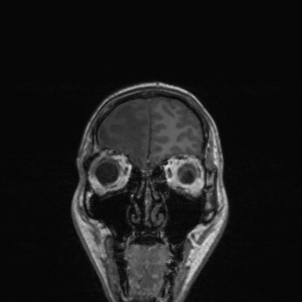 Cerebral abscess (Radiopaedia 24212-24478 Coronal T1 47).jpg