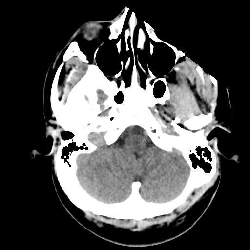 File:Cerebral abscess (Radiopaedia 29451-29919 Axial non-contrast 9).jpg