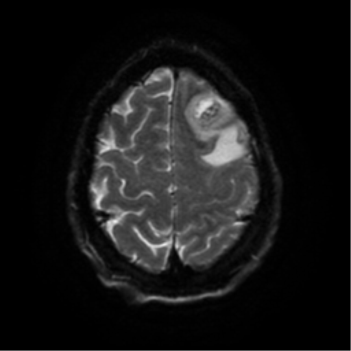 File:Cerebral abscess (Radiopaedia 57774-64740 Axial DWI 53).png