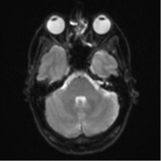 Cerebral abscess (Radiopaedia 60342-68009 Axial DWI 9).png