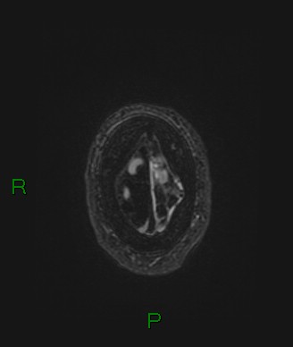 Cerebral abscess and subdural empyema (Radiopaedia 84436-99779 Axial FLAIR 11).jpg
