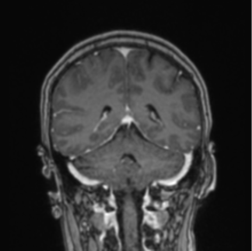Cerebral abscess from pulmonary arteriovenous malformation (Radiopaedia 86275-102291 L 33).png