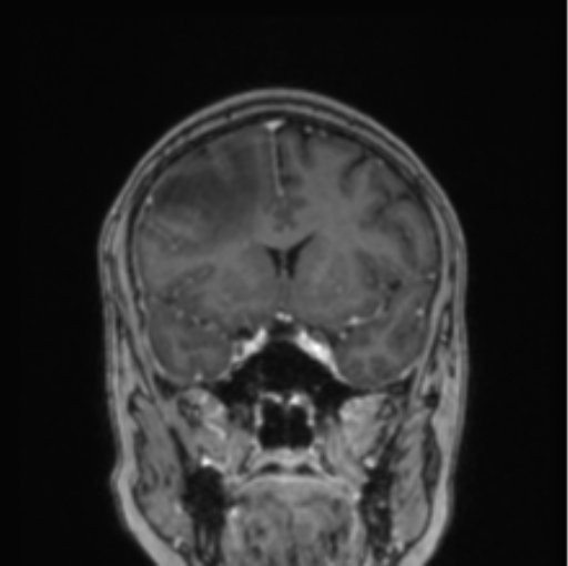 Cerebral abscess from pulmonary arteriovenous malformation (Radiopaedia 86275-102291 L 58).png