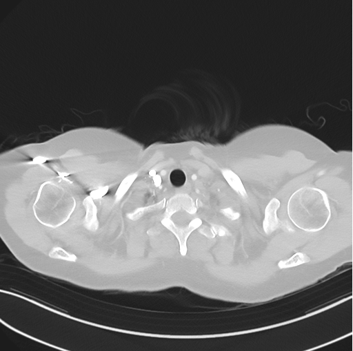 File:Cerebral abscess from pulmonary arteriovenous malformation (Radiopaedia 86275-102292 Axial lung window 7).png