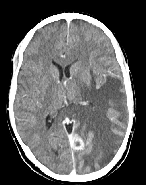 Cerebral abscesses (Radiopaedia 70458-80568 Axial Contrast 34).jpg