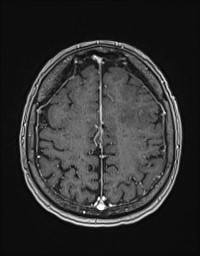Cerebral amyloid angiopathy-related inflammation (Radiopaedia 58270-65377 Axial T1 C+ fat sat 109).jpg