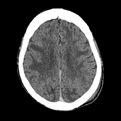 Cerebral amyloid angiopathy-related inflammation (Radiopaedia 74836-85848 Axial non-contrast 41).jpg