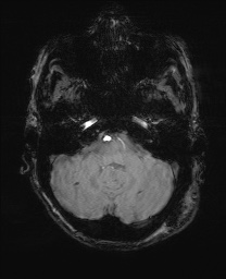 File:Cerebral amyloid angiopathy-related inflammation (Radiopaedia 74836-85849 Axial SWI 16).jpg