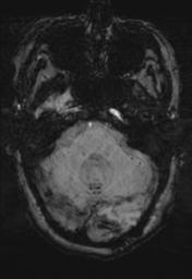 File:Cerebral amyloid angiopathy (Radiopaedia 29129-29518 Axial SWI MPR 8).jpg
