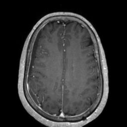 File:Cerebral amyloid angiopathy (Radiopaedia 29129-29518 Axial T1 C+ 101).jpg