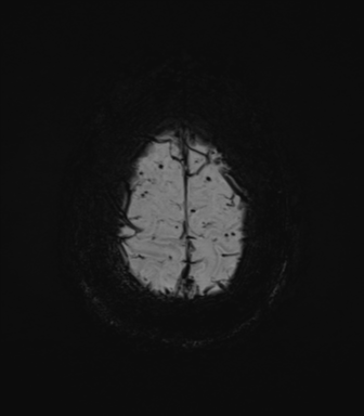 File:Cerebral amyloid angiopathy (Radiopaedia 46082-50433 Axial SWI MIP 73).png