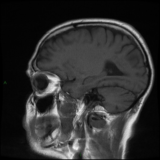 File:Cerebral amyloid angiopathy (Radiopaedia 77506-89664 Coronal T1 9).jpg