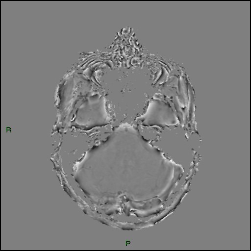 Cerebral amyloid angiopathy (Radiopaedia 77506-89664 H 30).jpg