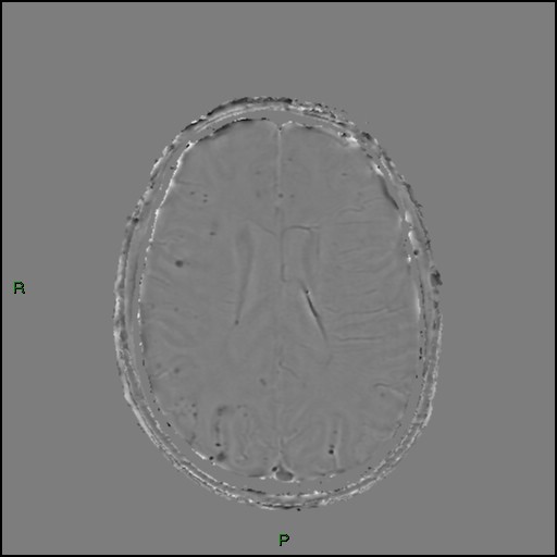 File:Cerebral amyloid angiopathy (Radiopaedia 77506-89664 H 64).jpg
