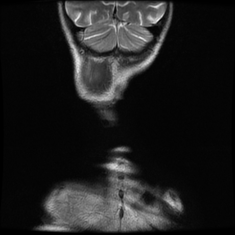 File:Cerebral and spinal tuberculosis (Radiopaedia 90489-107838 Coronal 1).jpg