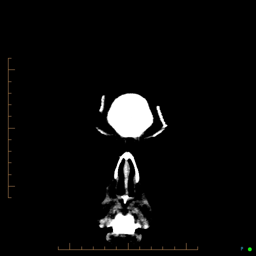 Cerebral arteriovenous malformation (AVM) (Radiopaedia 78162-90706 Coronal non-contrast 6).jpg