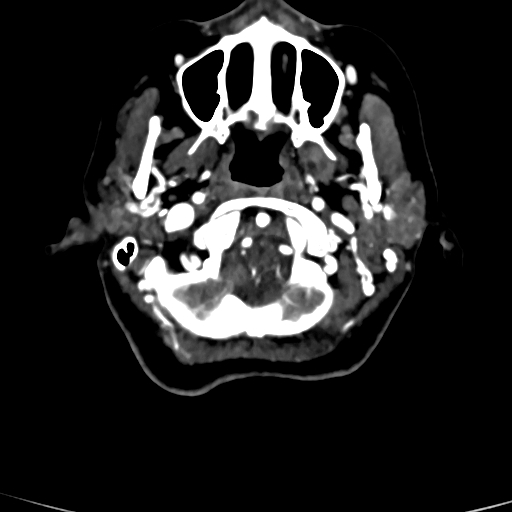 Cerebral arteriovenous malformation (Radiopaedia 73830-84645 Axial C+ delayed 88).jpg