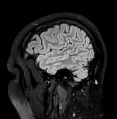 Cerebral arteriovenous malformation (Radiopaedia 74411-85746 Sagittal FLAIR 14).jpg