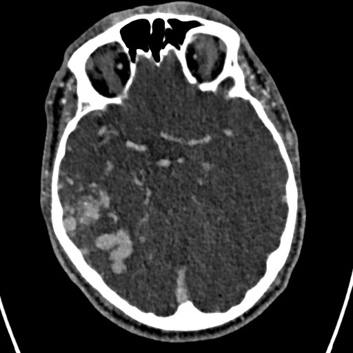 Cerebral arteriovenous malformation (Radiopaedia 78188-90746 Axial C+ delayed 68).jpg
