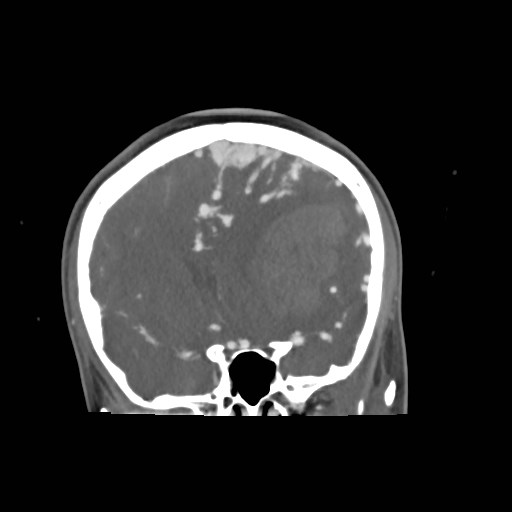 File:Cerebral arteriovenous malformation (Radiopaedia 79677-92888 B 13).jpg