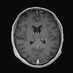 Cerebral arteriovenous malformation (Radiopaedia 84015-99245 Axial T1 C+ 92).jpg