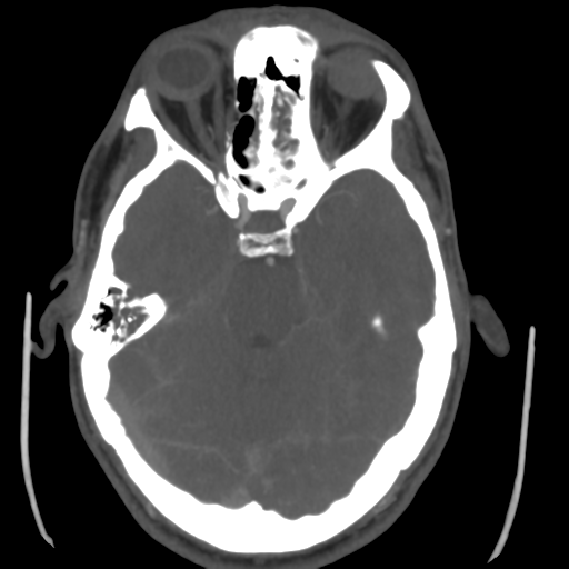 Cerebral arteriovenous malformation (Spetzler-Martin grade 2) (Radiopaedia 41262-44076 E 19).png