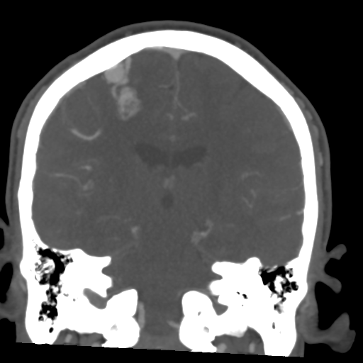 Cerebral arteriovenous malformation (Spetzler-Martin grade 2) (Radiopaedia 41262-44076 F 37).png