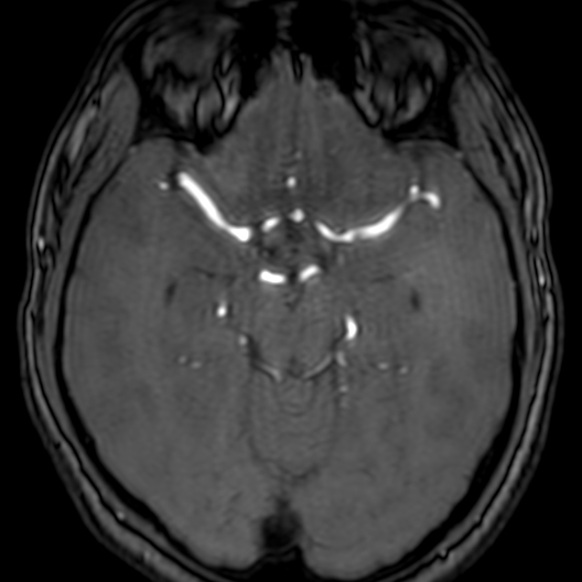 Cerebral arteriovenous malformation at posterior body of corpus callosum (Radiopaedia 74111-84925 Axial MRA 81).jpg