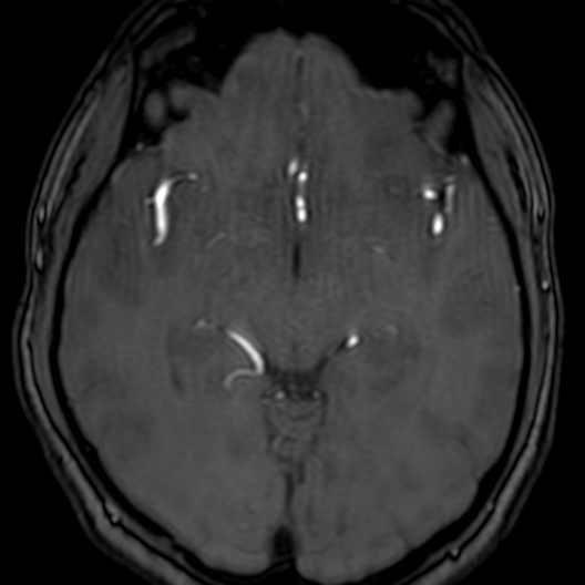 Cerebral arteriovenous malformation at posterior body of corpus callosum (Radiopaedia 74111-84925 Axial MRA 92).jpg