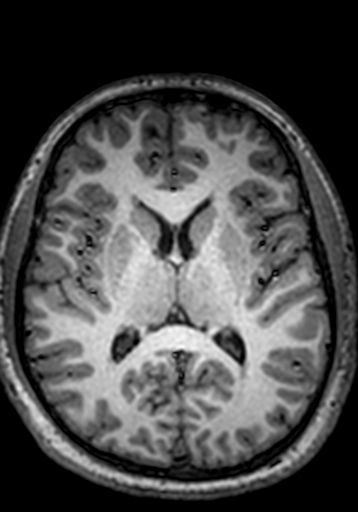 Cerebral arteriovenous malformation at posterior body of corpus callosum (Radiopaedia 74111-84925 Axial T1 134).jpg