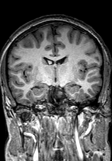 Cerebral arteriovenous malformation at posterior body of corpus callosum (Radiopaedia 74111-84925 Coronal T1 158).jpg