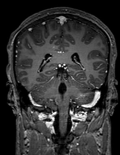 Cerebral arteriovenous malformation at posterior body of corpus callosum (Radiopaedia 74111-84925 K 242).jpg