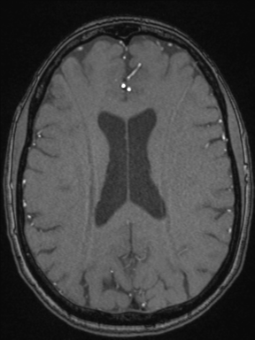 Cerebral arteriovenous malformation with hemorrhage (Radiopaedia 34422-35737 Axial MRA 52).png