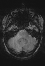 File:Cerebral cavernoma and development venous anomaly (Radiopaedia 37603-39482 Axial SWI 10).png