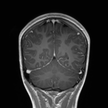 Cerebral cavernous venous malformation (Radiopaedia 70008-80021 Coronal T1 C+ 18).jpg