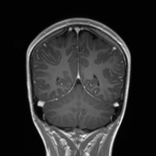 Cerebral cavernous venous malformation (Radiopaedia 70008-80021 Coronal T1 C+ 19).jpg