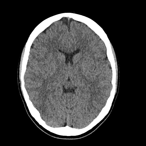 Cerebral cavernous venous malformation (Radiopaedia 70008-80022 Axial non-contrast 24).jpg