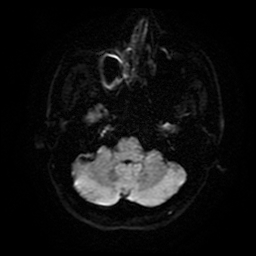Cerebral cavernous venous malformation (Zabramski type II) (Radiopaedia 85511-101198 Axial DWI 8).jpg